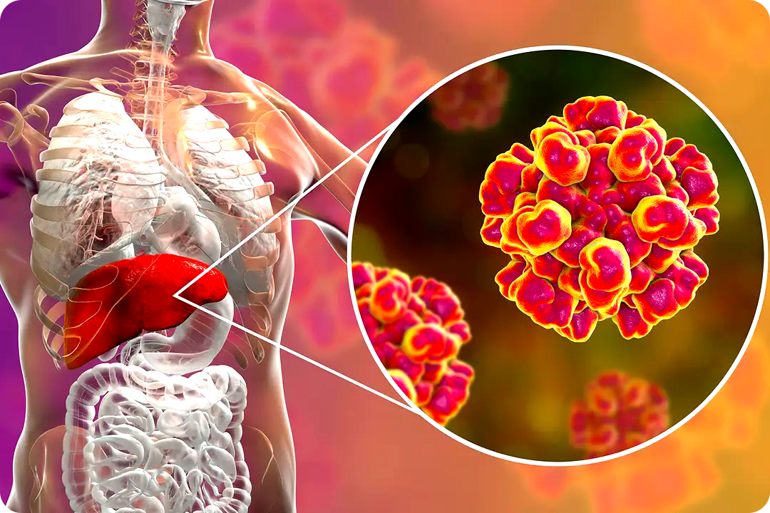 Ayurvedic treatment for Hepatitis